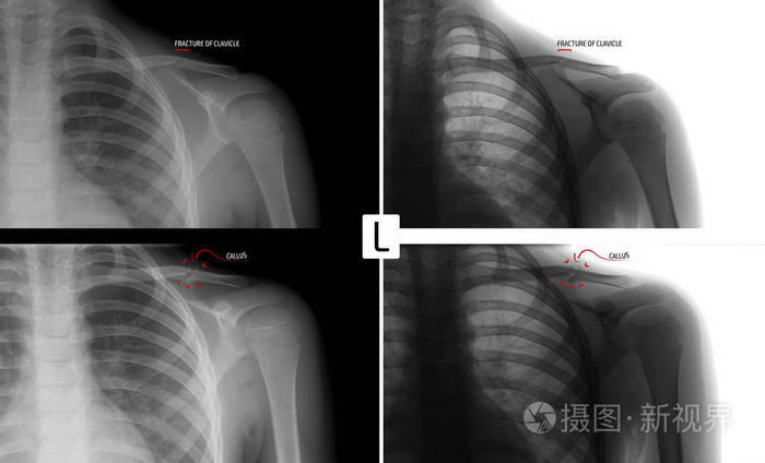 儿童锁骨骨折.骨折合并.标记.积极.负面