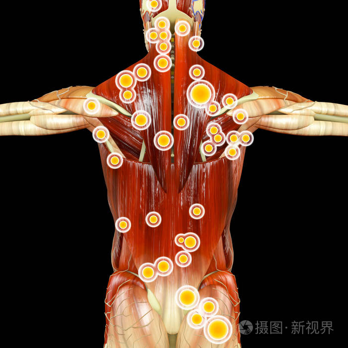 肌筋膜触发点, 被描述为 hyperirritable 斑在筋膜周围的骨骼肌肉