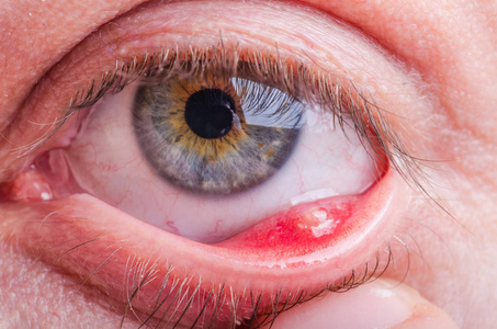 麦粒肿 麦粒肿 病在高加索女性眼中的研究