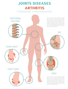 关节疾病。关节炎症状, 治疗图标设置。医疗图表设计。矢量插图
