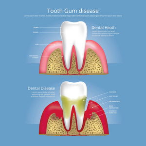 人类牙齿牙龈疾病矢量图阶段图片