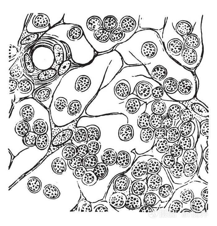 淋巴管圆细胞肉瘤复古雕刻插图