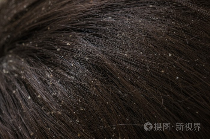 在干燥的头发在头上的白色头皮屑片