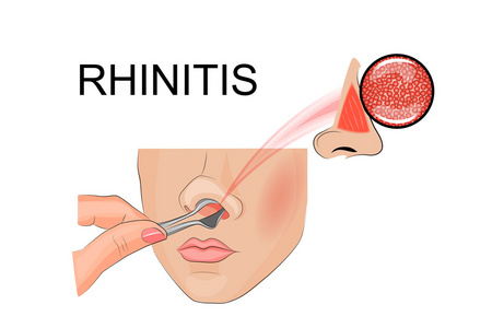 鼻腔内的检验图片