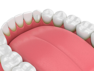 3d 在白色背景上有斑块和牙垢的牙齿的渲染