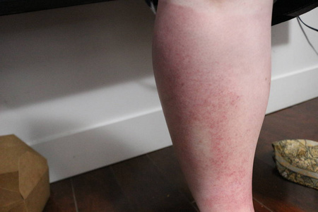 可怕的太阳烧伤女性腿, 已导致太阳中毒