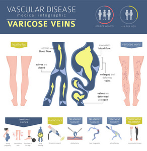 血管疾病。静脉曲张症状, 治疗图标设置。医疗图表设计。矢量插图
