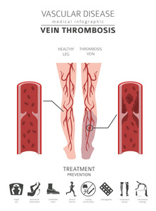 血管疾病。静脉血栓形成症状, 治疗图标设置。医疗图表设计。矢量插图