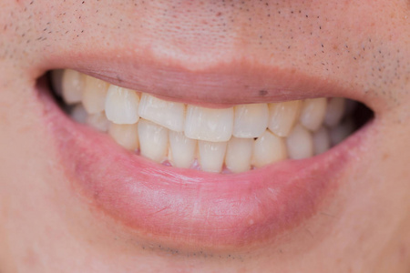 丑陋的笑容牙齿的问题。牙齿受伤或打破男性的牙齿。创伤和神经损伤的伤齿，恒牙损伤