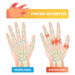 手指关节炎向量例证。健康和疾病影响的关节
