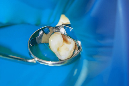 人牙龋病的治疗。用复合材料修复牙齿牙齿的概