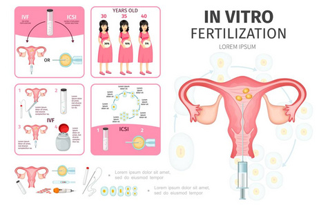 扁平体外受精图表概念