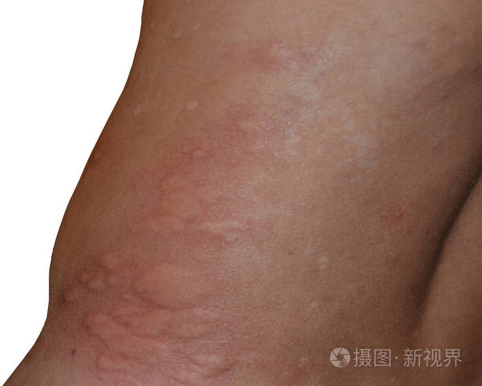 过敏皮肤背部和两侧.皮肤红肿红肿的过敏反应