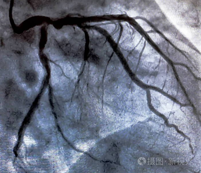 插管心脏脑室造影是一种医学影像学测试用于确定患者在右心室或左心室