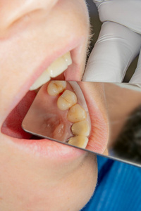 牙科诊所的牙科治疗。腐烂的龋牙特写宏。牙髓管的治疗