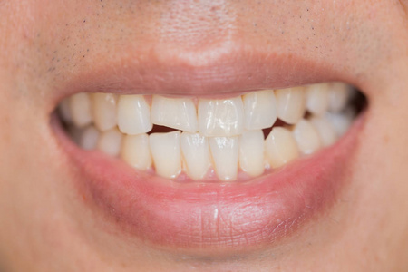 特写的嘴牙齿的问题。牙齿受伤或打破男性的牙齿。创伤和神经损伤的伤齿，恒牙损伤