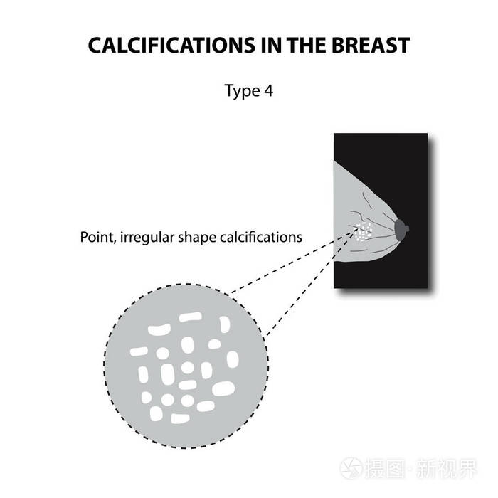 在乳房钙化。乳腺放射成像。乳腺。信息图表。