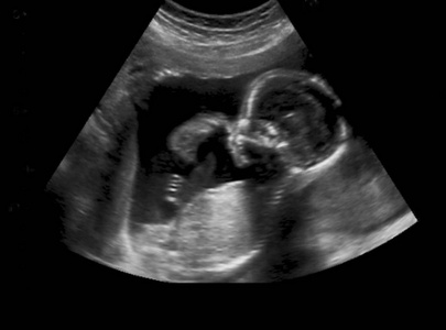 婴儿在母亲的子宫超声检查
