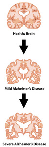 阿尔茨海默疾病例证的阶段图片