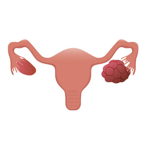 子宫多囊卵巢图示