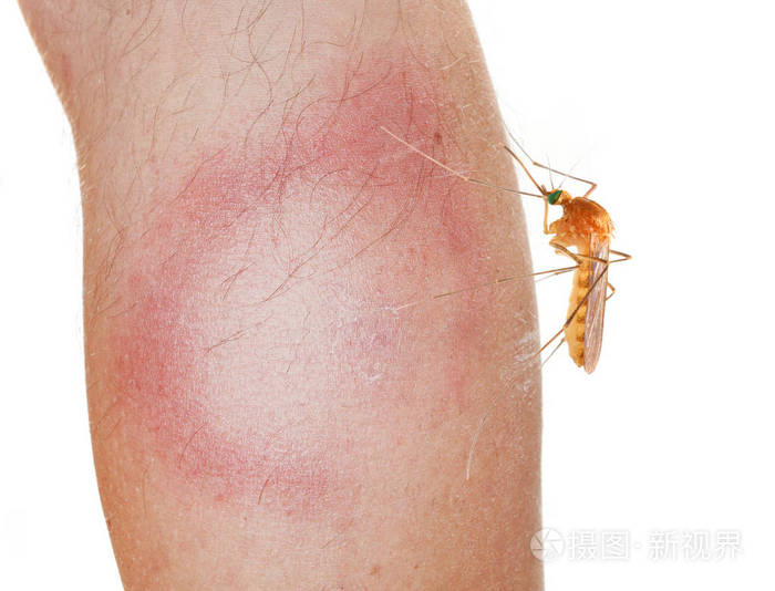 蚊子和游走性红斑皮疹