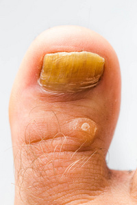 指甲上的真菌感染