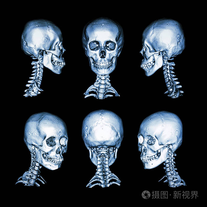 ct扫描和三维图像正常的人类头骨和颈椎所有方向