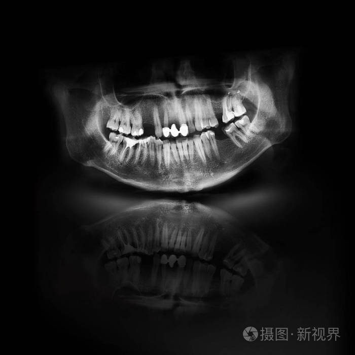 黑色x射线颅颌齿