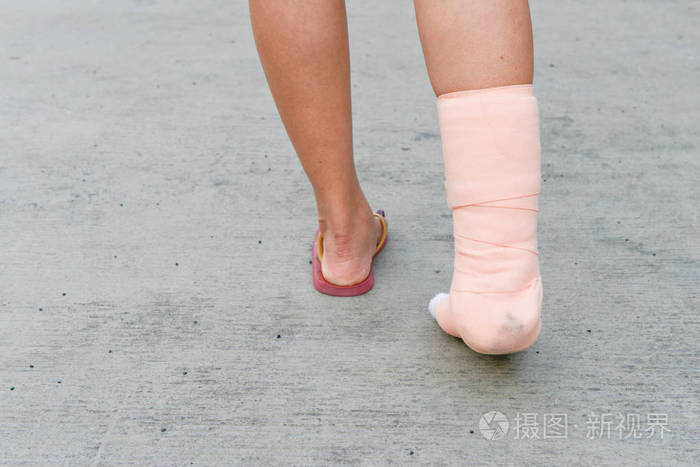 妇女脚和腿上的夹板照片-正版商用图片0wrj47-摄图新视界
