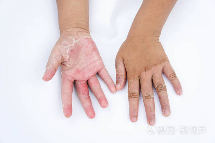 干手, 剥离, 接触性皮炎, 真菌感染照片-正版商用图片0x86sr-摄图新