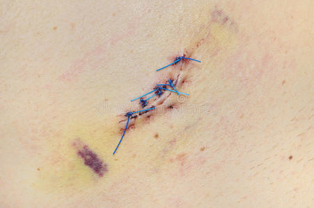 男性背部皮肤活检后缝合的伤口。