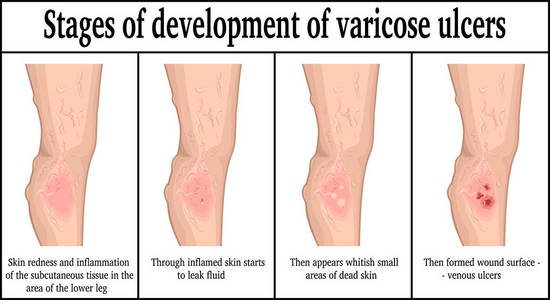 静脉曲张溃疡发展阶段图片