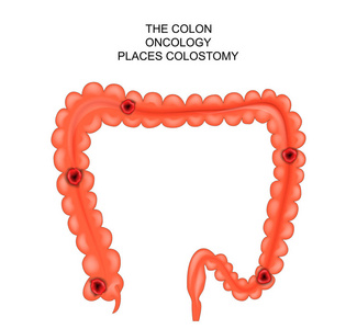 结肠造口术。地方外科干预