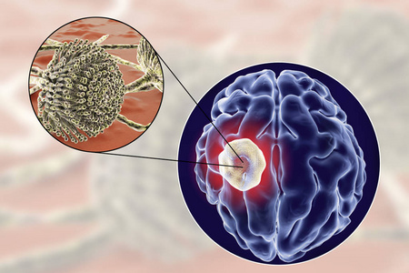 曲菌球病的真菌曲霉大脑和特写视图