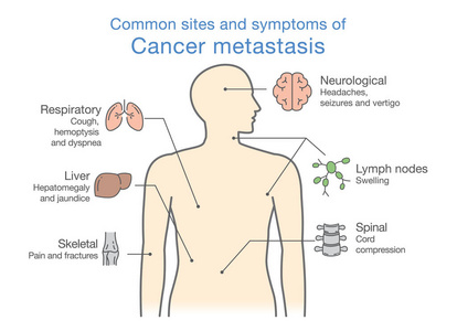 最常见的网站和癌症转移症状