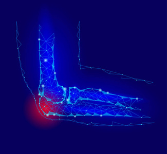 疼痛的肘关节疾病。红痛区低聚 geomentic 未来医学概念创新技术。手臂损伤多边形矢量图示