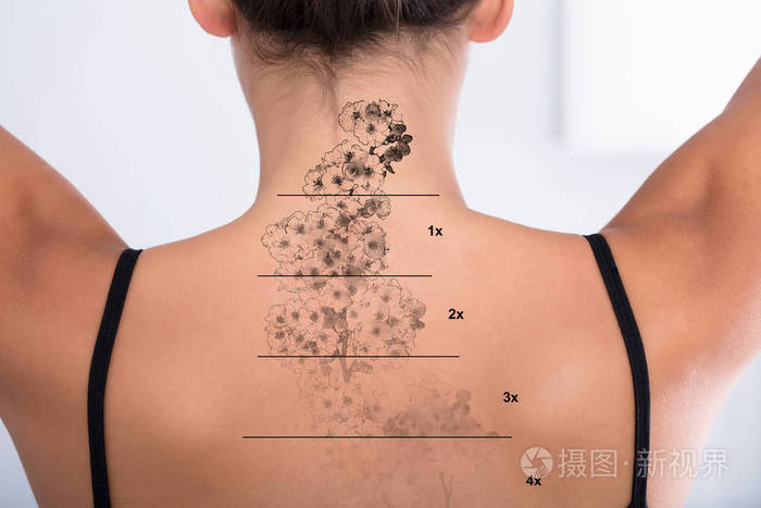 女性背部纹身去除