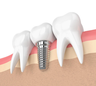 3d 牙齿植入牙在牙龈中的呈现