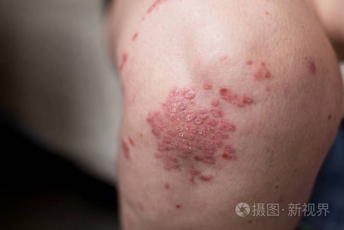 一个白种女人与牛皮癣, 湿疹, 过敏性皮炎的腿部皮肤.