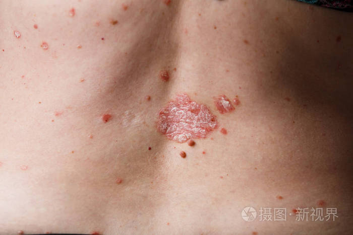女性有皮疹和瘙痒性皮肤皮炎问题的背部视图湿疹皮肤质地