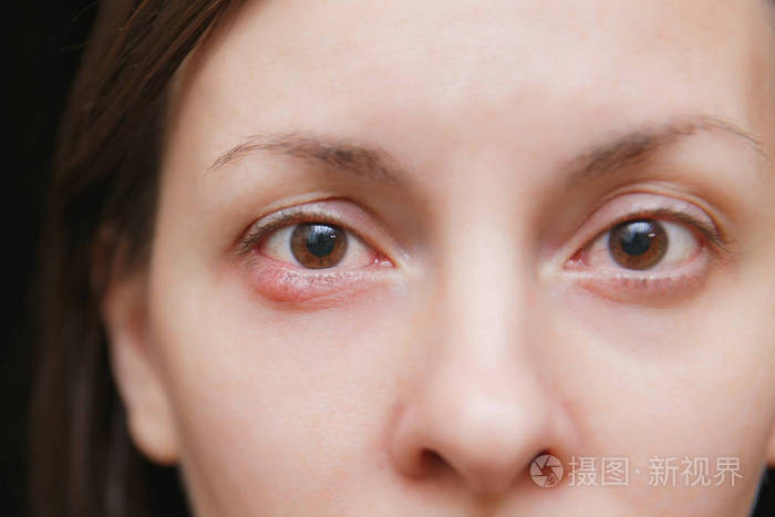 关闭年轻的白种人棕褐色的女人的眼睛感染, 眼睑脓肿
