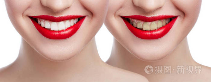 牙齿美白后 美白前后的女性牙齿 幸福的微笑女人的脸贴近了.