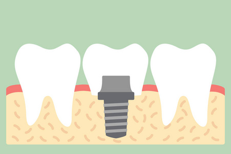 牙种植冠, 解剖学结构包括骨头和口香糖