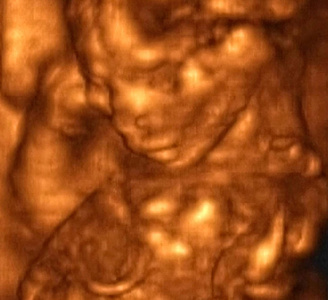 意大利4月胎儿实验室三维超声分析