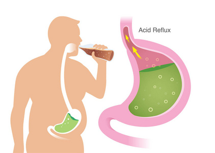 脂肪人的轮廓，而喝碳酸饮料有酸反射在胃。 胃食管反流病的图解。