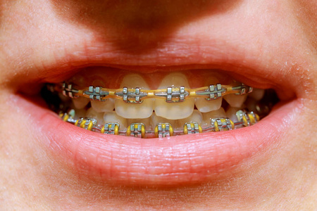 漂亮的白色牙齿和牙套的拍摄。 牙科护理照片。 美女微笑与口腔配件。 正畸治疗。 健康女性口腔特写