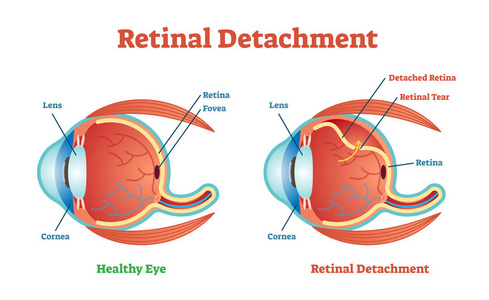 视网膜脱离矢量图示图, 解剖方案