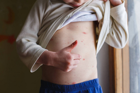 婴儿水痘皮疹。水痘或水痘泡疹儿童。皮肤病学概念。孩子在他的腹部显示瑕疵