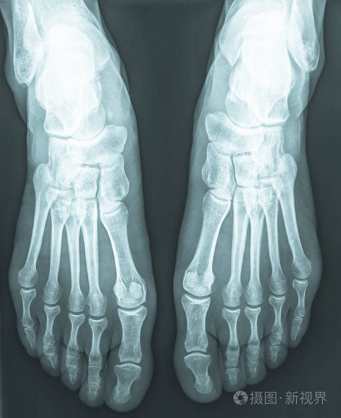 人类女性脚骨x线片