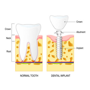 牙科植入物和正常牙齿